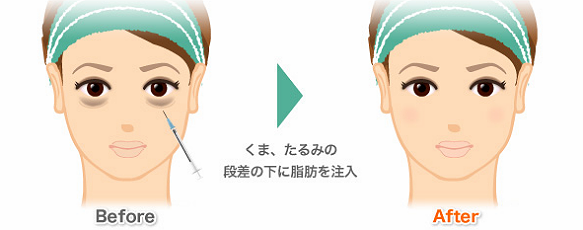 脱脂術+リボトランスファーの画像